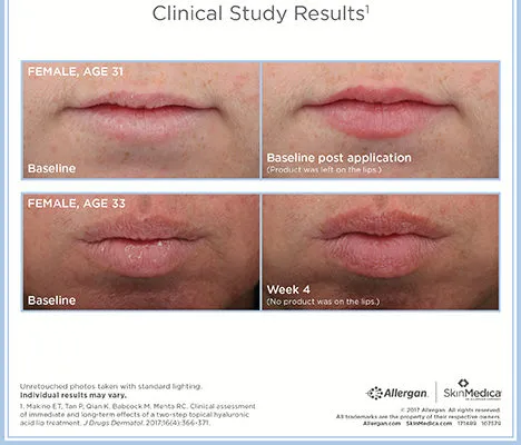 SkinMedica HA5 Smooth and Plump Lip System